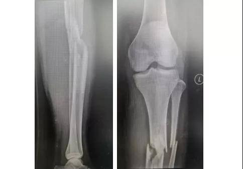 手术|小伙骑车摔倒粉碎性骨折，三中心“髌上入路髓内钉”手术让小伙转危为安