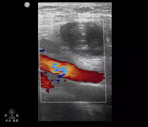 血管|神经血管介入中心联合超声科完成超声引导下凝血酶注射治疗假性动脉瘤