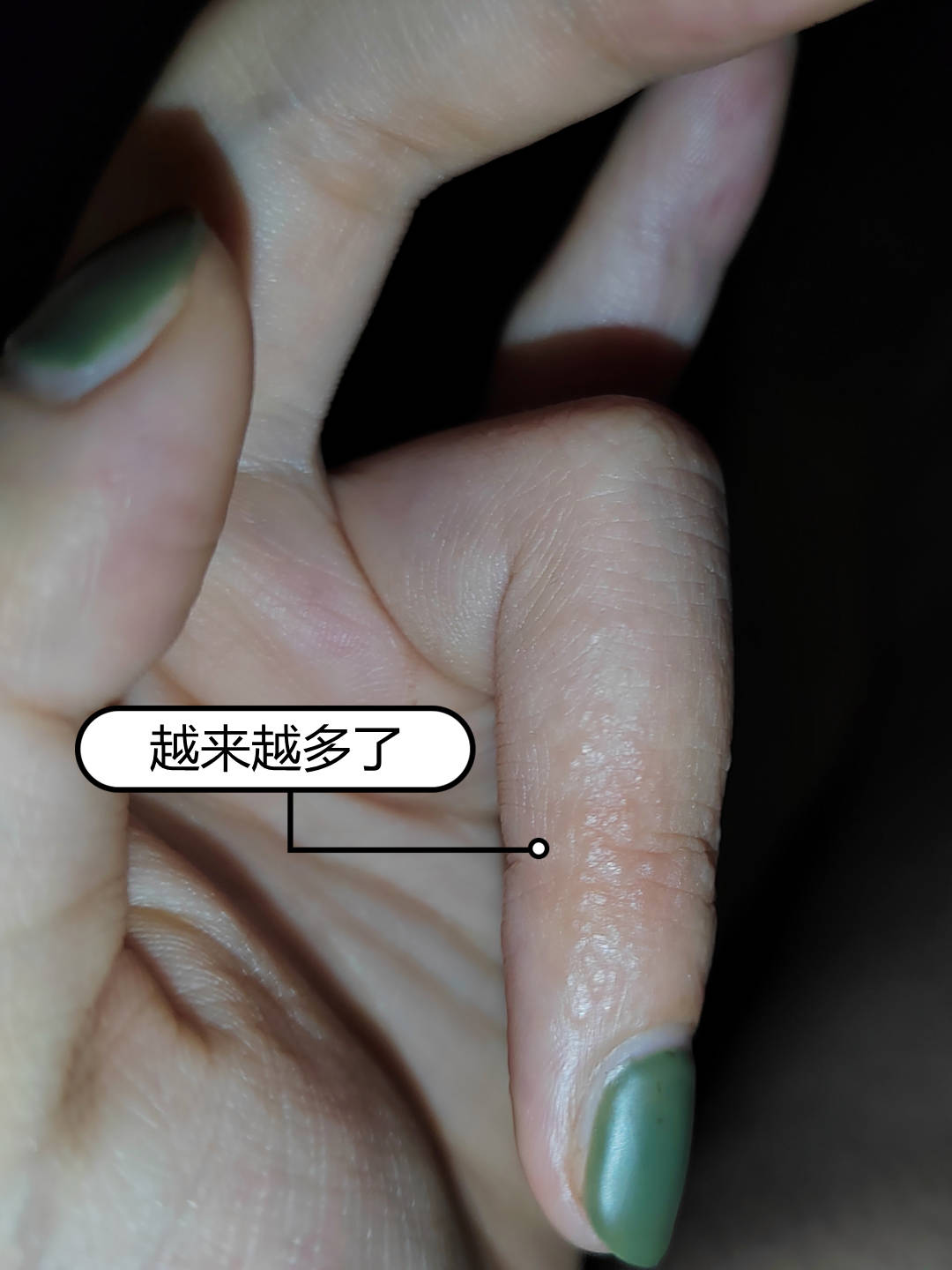 原创手指上起密密麻麻的小水泡,痒,该怎么办?
