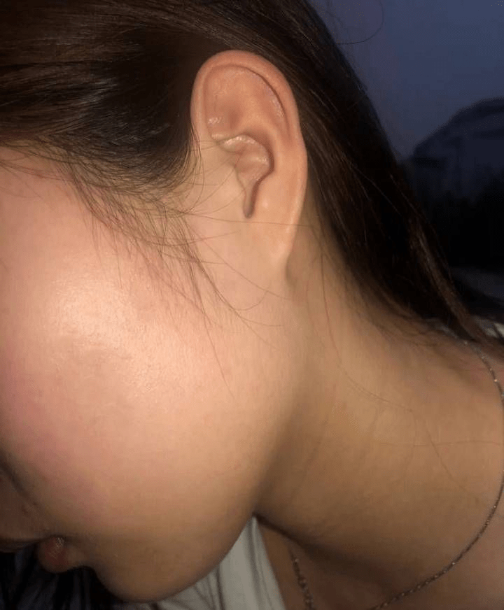 方法湿疹用什么药好得最快?这几种方法你一定要了解