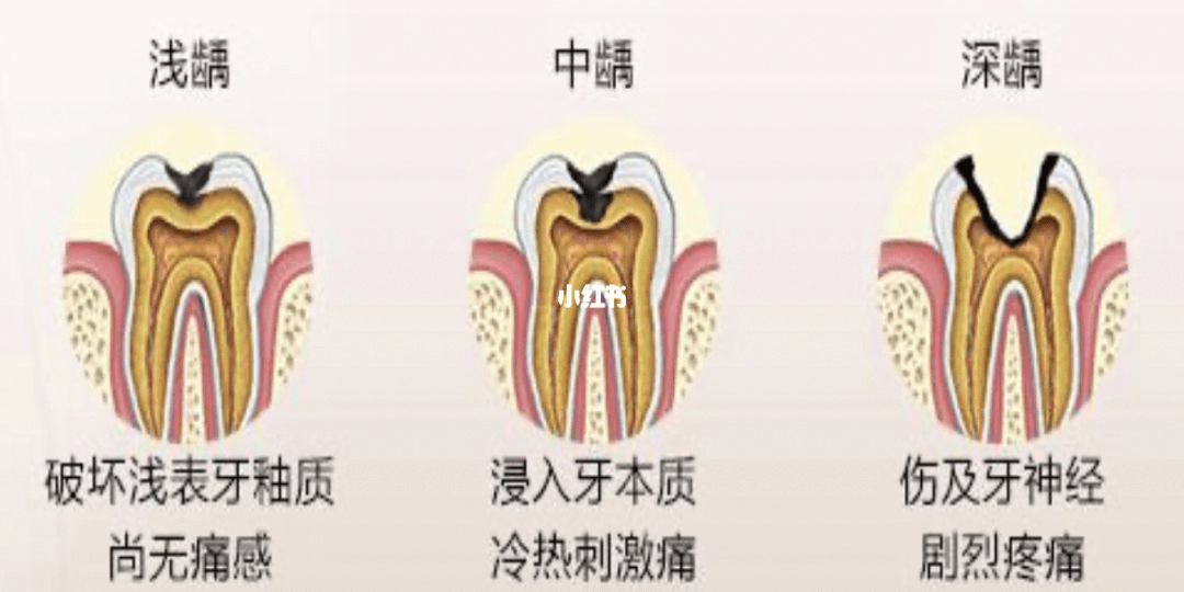 蛀牙齲齒如何預防?健康師彙總最全蛀牙預防方法_牙齒