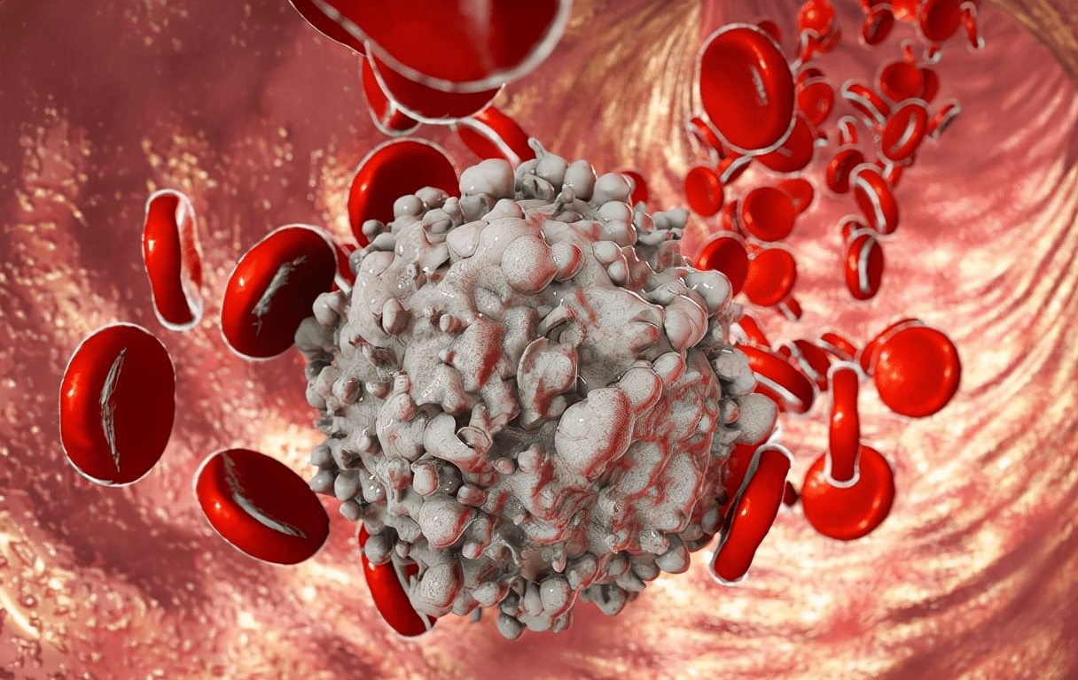 白血病初期小红点图片（血癌早期的红点图片）