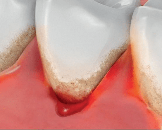 大牙后面的牙肉肿痛怎么办