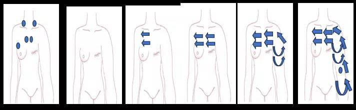 治疗|徒手引流！乳腺癌术后淋巴水肿有个防治“绝招”！