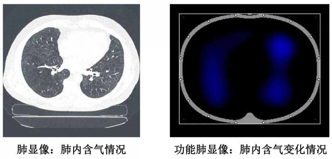 动态|无辐射“动态CT”助力救治多名重症患者
