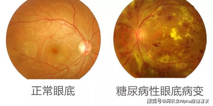 症状|关于糖尿病,还有哪些是你不知道的?