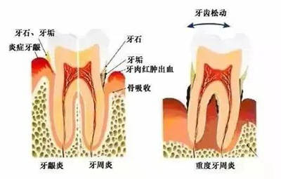 怎么能让牙龈更稳固 c6ba58338b614536a10e8c90d7ccdb51.jpeg