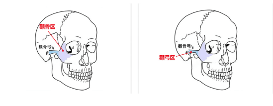 颧骨圣嘉新张笑天：颧骨内容容易下垂的原因有哪些？