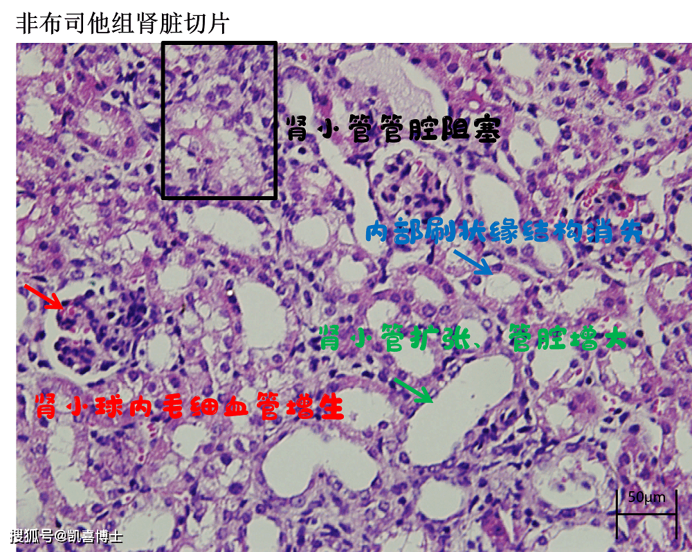 部分小鼠的肾脏样本,存在肾小球内毛细血管增生,肾小管扩张,管腔增大