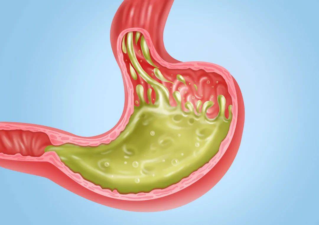 什么|经常反酸、烧心是什么症状？怎么改善呢？