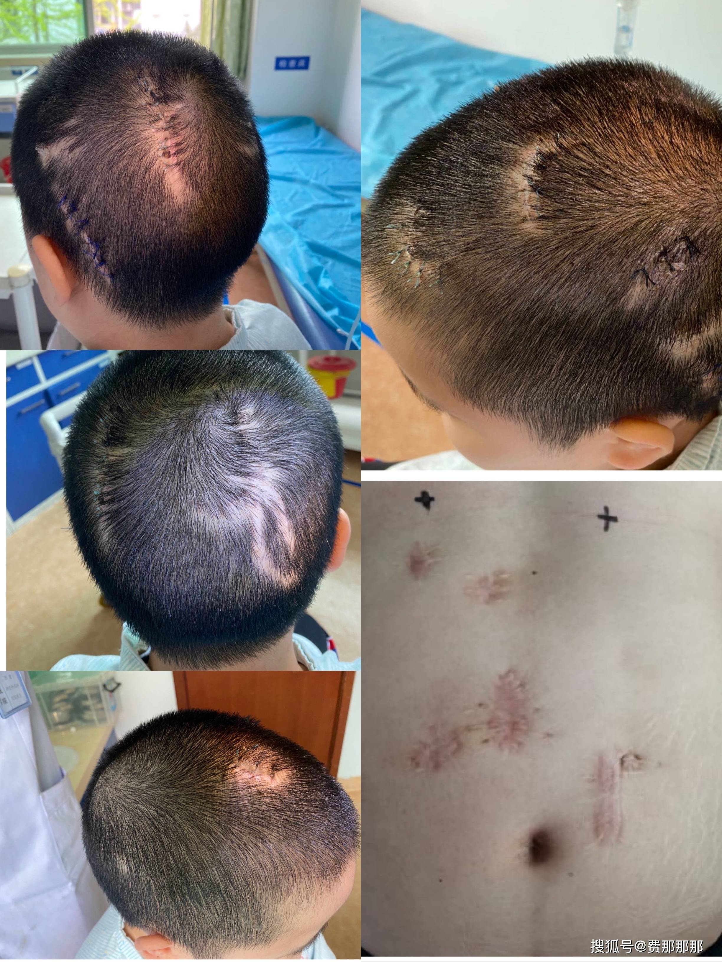 未见分流管,考虑管端脱落;于是到北大妇幼就诊,经尿道排除膀胱分流管