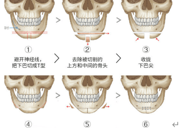 下巴张笑天改脸型：下巴前突怎么解决？颏成型手术适合哪些人？