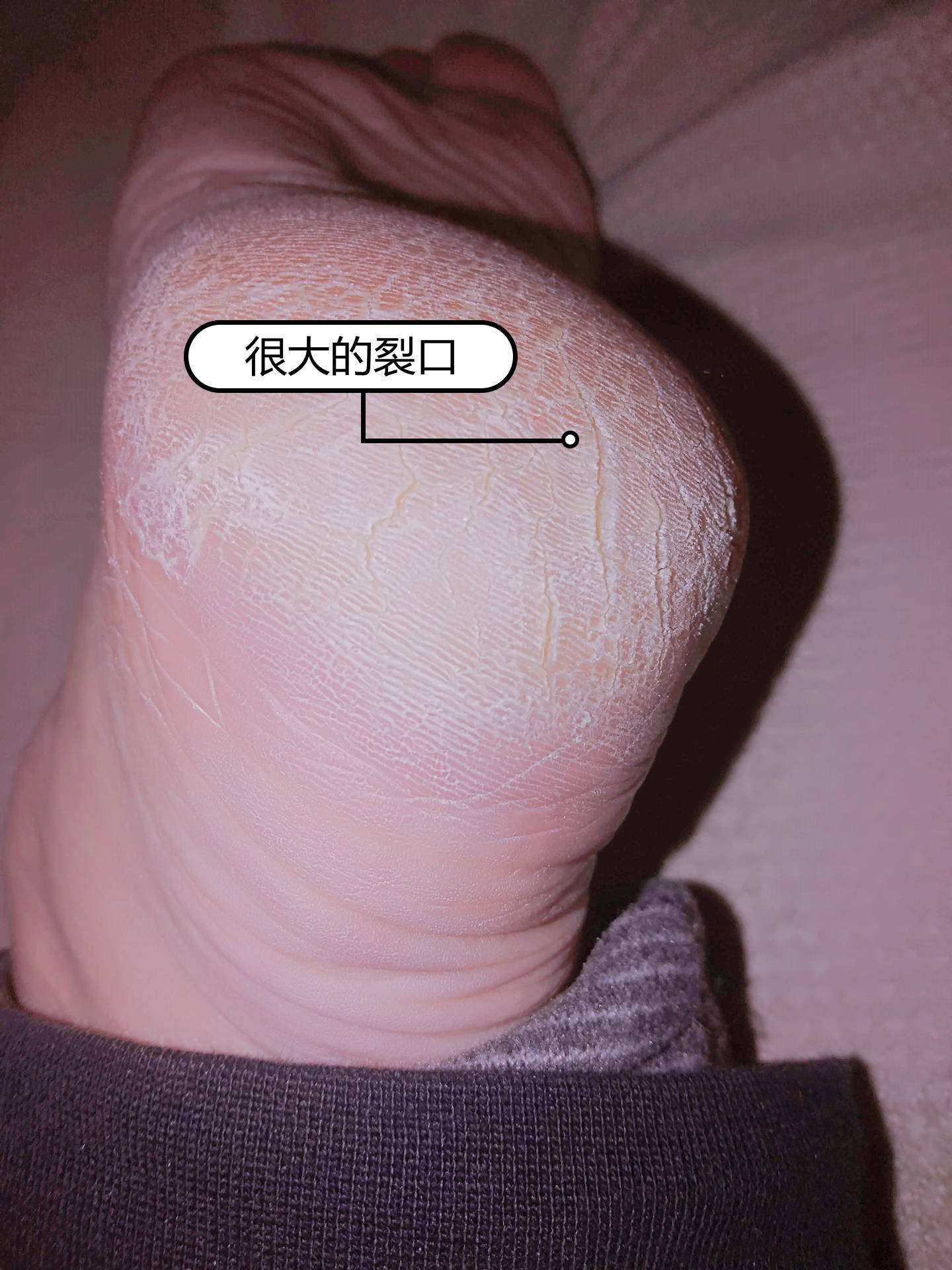 住在北方脚后跟起硬皮裂的口子疼怎么办