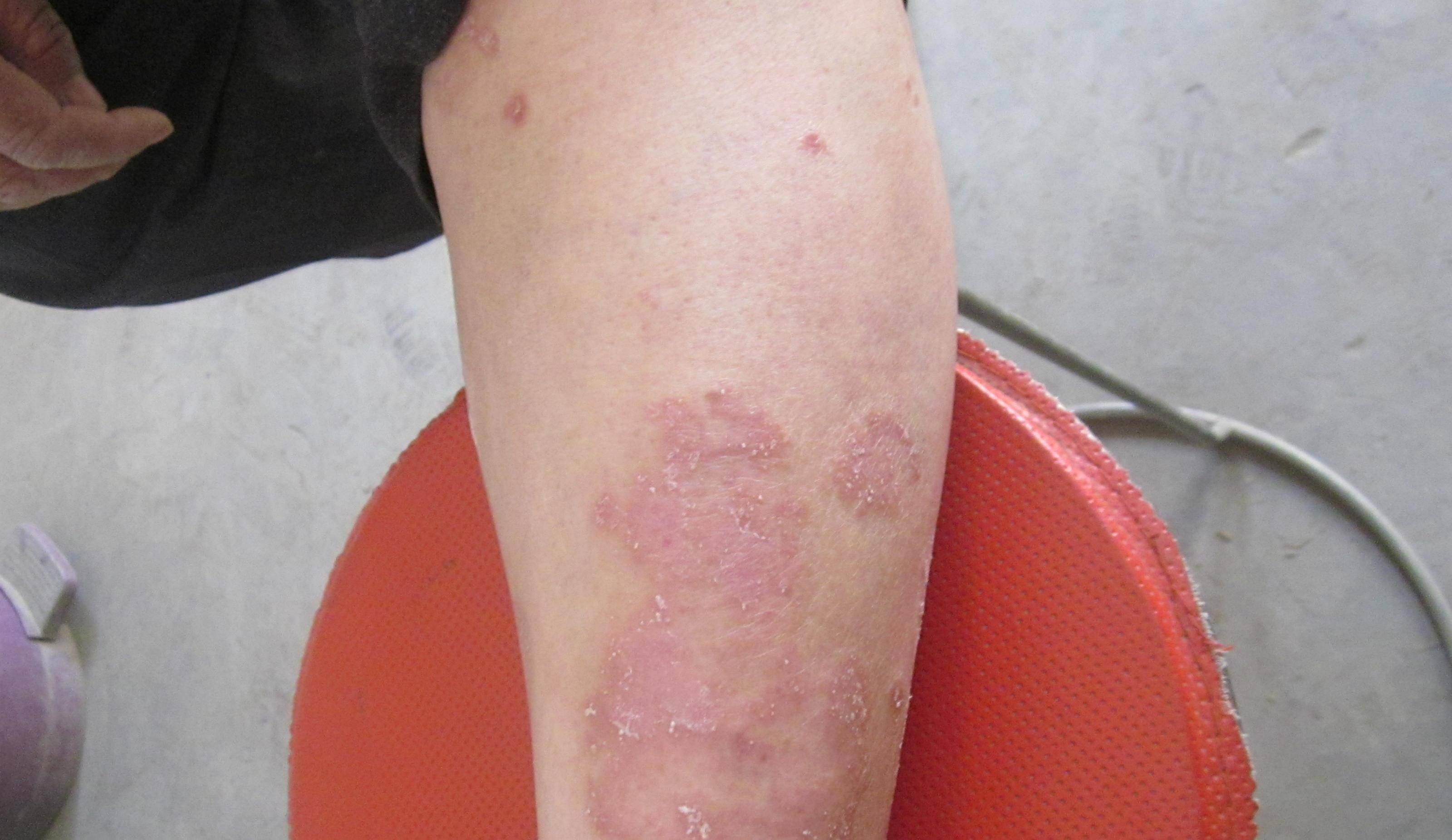 长春肤康医院浅谈:蜂胶可以治疗银屑病吗?_患者