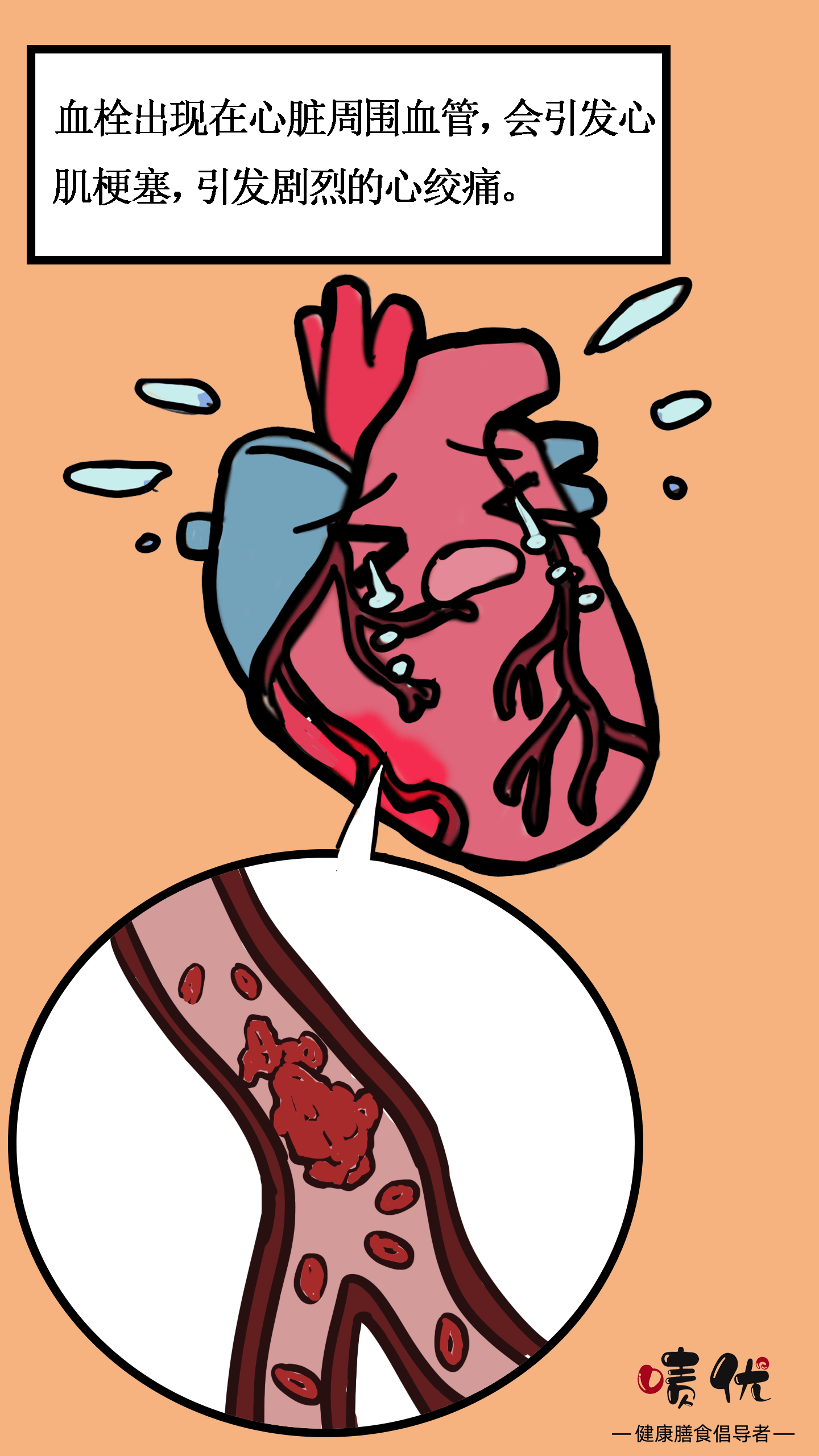 漫画一图读懂血栓是怎么形成的