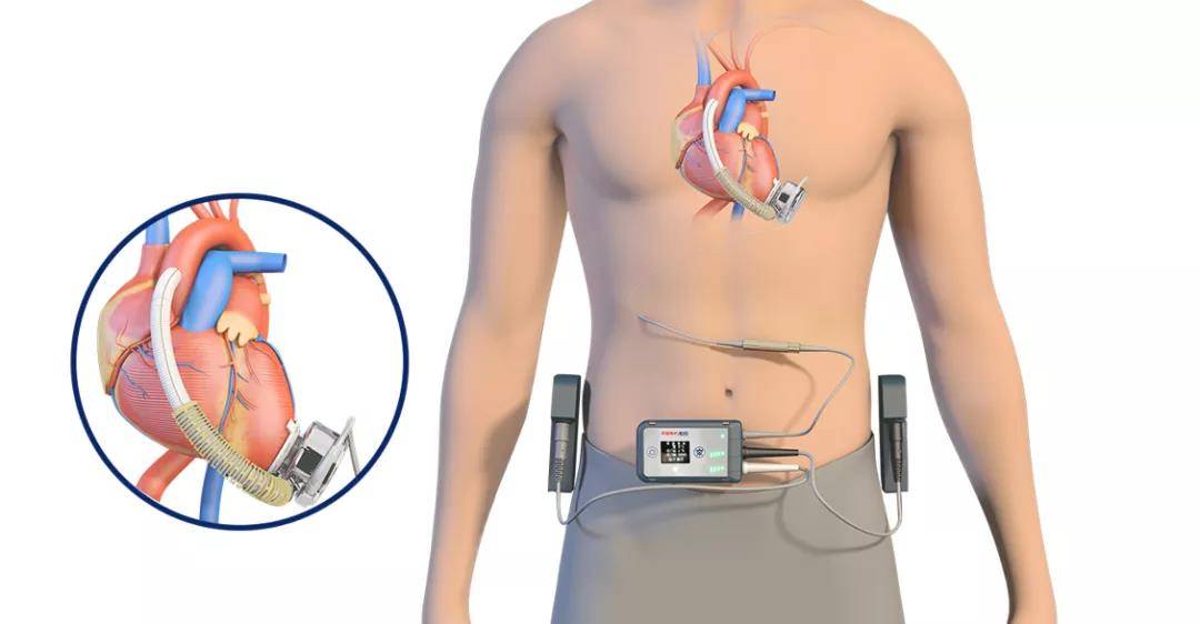 该产品的核心技术主要为全磁悬浮血泵技术,目前取得中国和美国多项