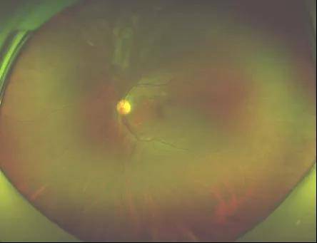 王海燕|莫要谈“艾”色变，关注艾滋患者的眼健康