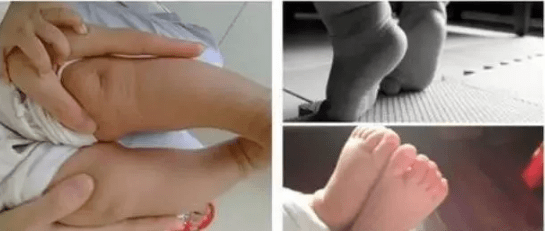 腓骨|脑瘫马蹄内翻手术该如何选择？