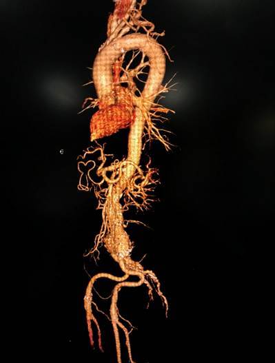 团队|患者术前反复发烧 西安交大一附院医生抽丝剥茧发现极罕见病例