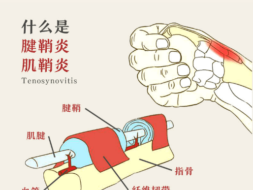 《特乐扩运动防护前沿资讯》 2021年12月6日|星期一_肌腱_腱鞘_董冰