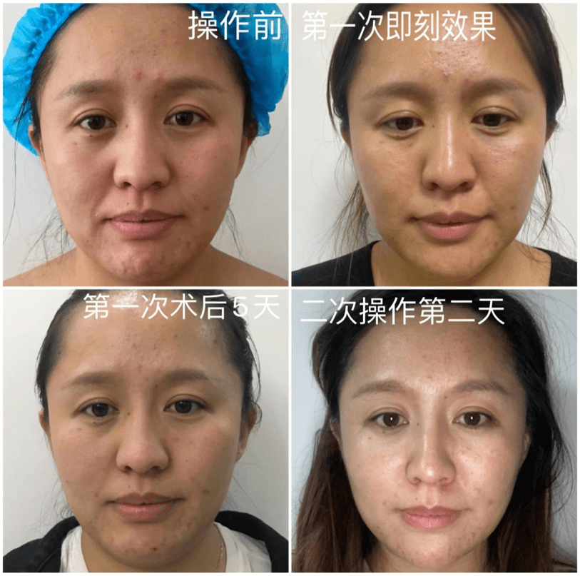 方法肉肉脸和干瘦脸，抗衰方法不一样，选对了才能快速变美
