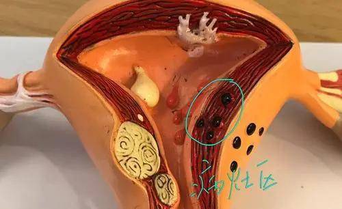 子宫腺肌症包括子宫肌瘤,在医学上都叫做"雌激素依赖性疾病",较高的雌