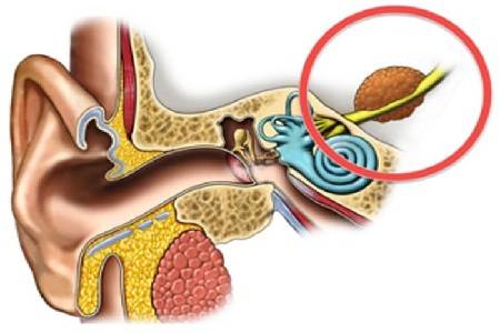 主要是因為腫瘤在咽隱窩或咽鼓管圓枕區,由於腫瘤浸潤,壓迫咽鼓管咽口