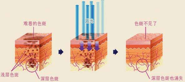 雀斑“斑”门弄斧，天玑雪教科学祛斑~