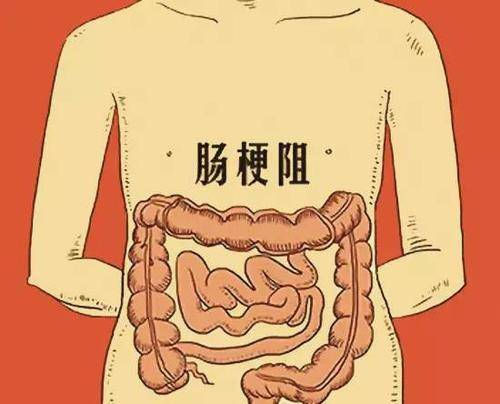 高位肠梗阻图片