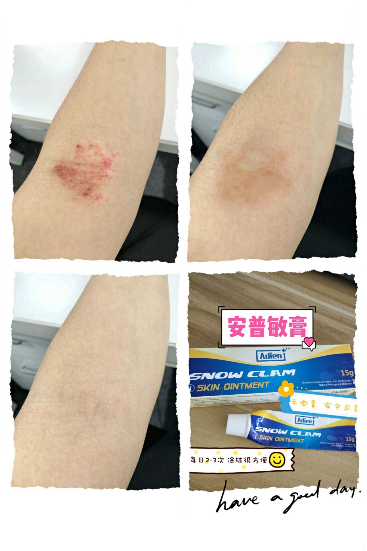 冬天到了干性湿疹总是找上门