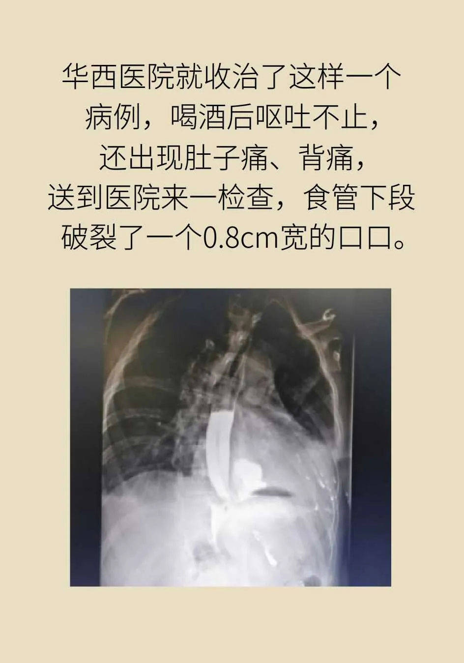 健康過年酒醉嘔吐有多兇險這一回食管哭了