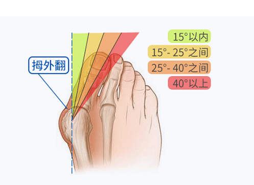 牛江红拇外翻的真面目