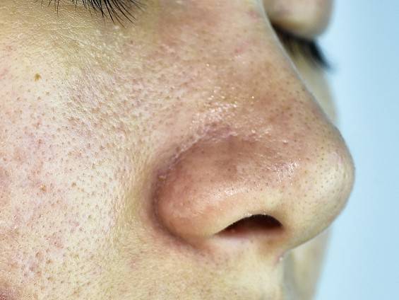 本色肤雕脸油毛孔粗大又爆痘该怎么管理