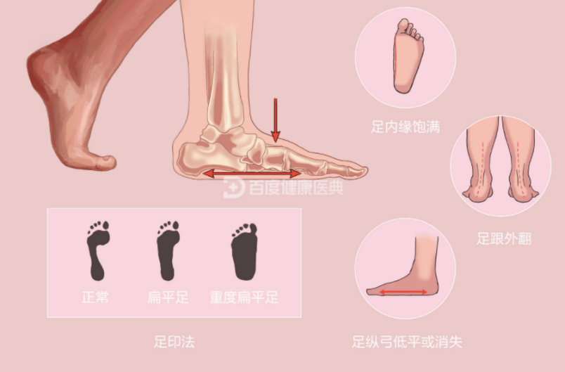拉低生活质量的"凶手",扁平足应如何用矫正鞋垫矫正
