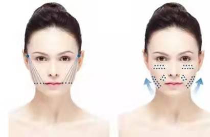 什么做线雕有什么好处,做线雕会不会有什么后遗症知道的聊聊~