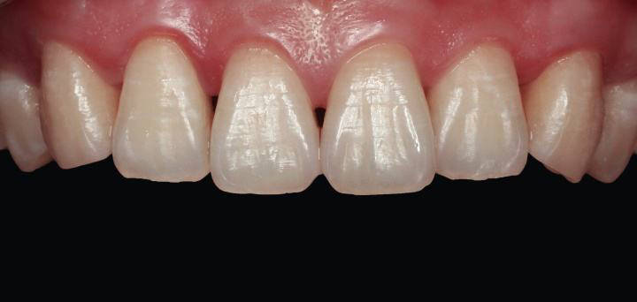 格伦菲尔杨阳医生邻面去釉牙齿片切常见的4个问题