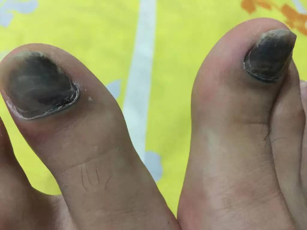 治愈美甲竟会诱发灰指甲？康复者含泪分享，彻底治愈灰指甲还得这样做！