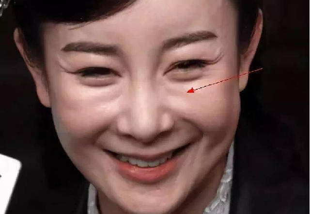 因为泪沟填充产品用什么好？轻医美填充产品大盘点！