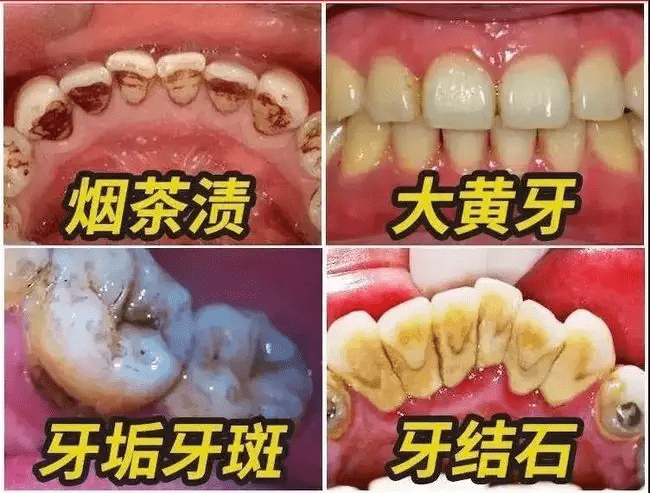 其次,加深牙齒變黃的原因又有很多種:最外層的