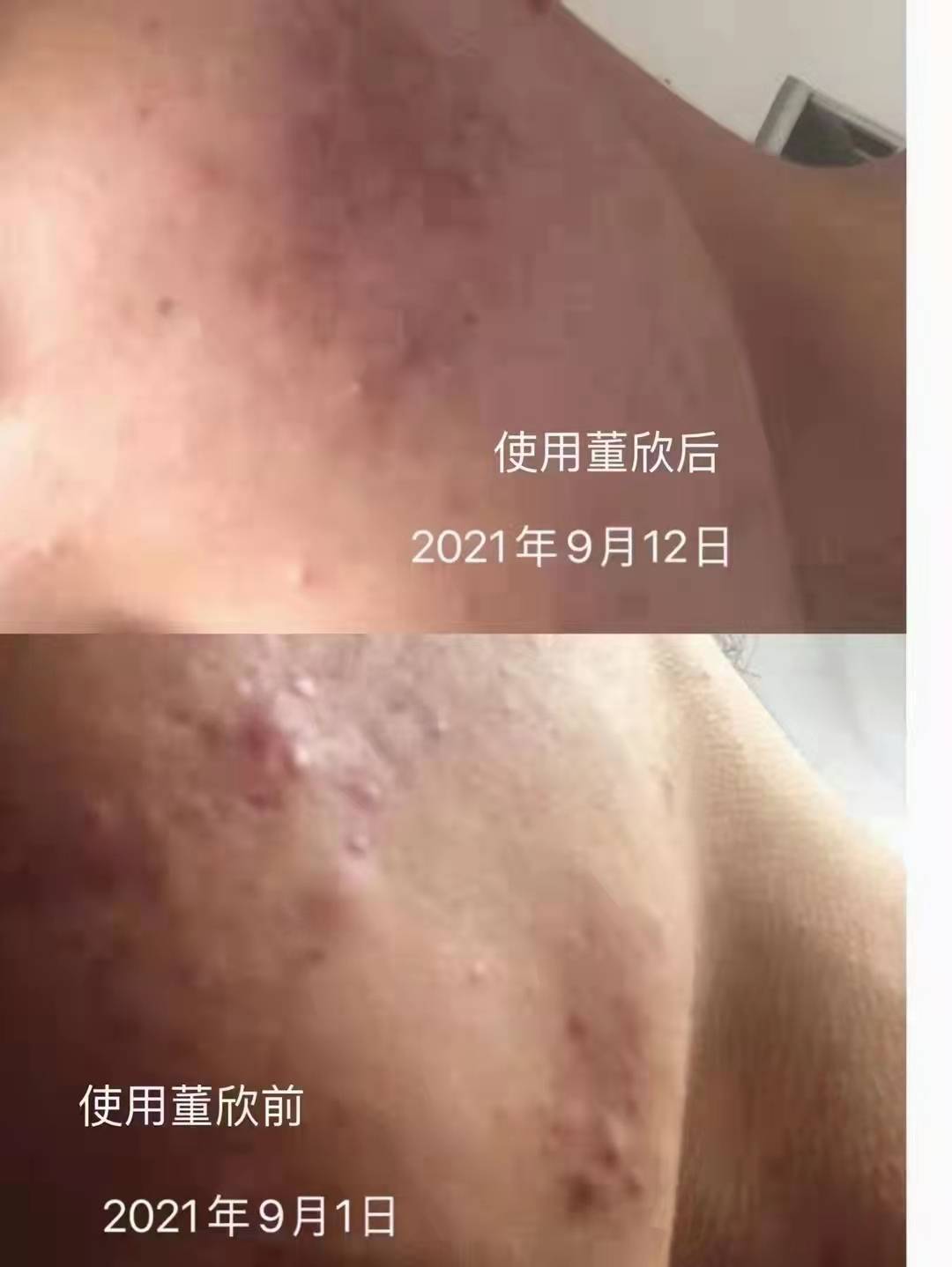 方法董欣薰衣草纯露消炎功效好嘛？痘痘肌敏感肌使用方法