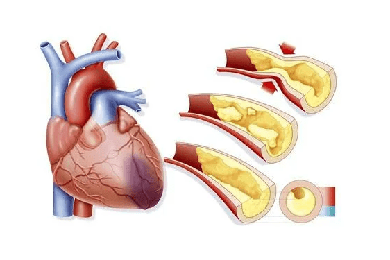 心臟是人體的發動機,它會把血液泵到全身各處,一但心肌缺血,會導致它