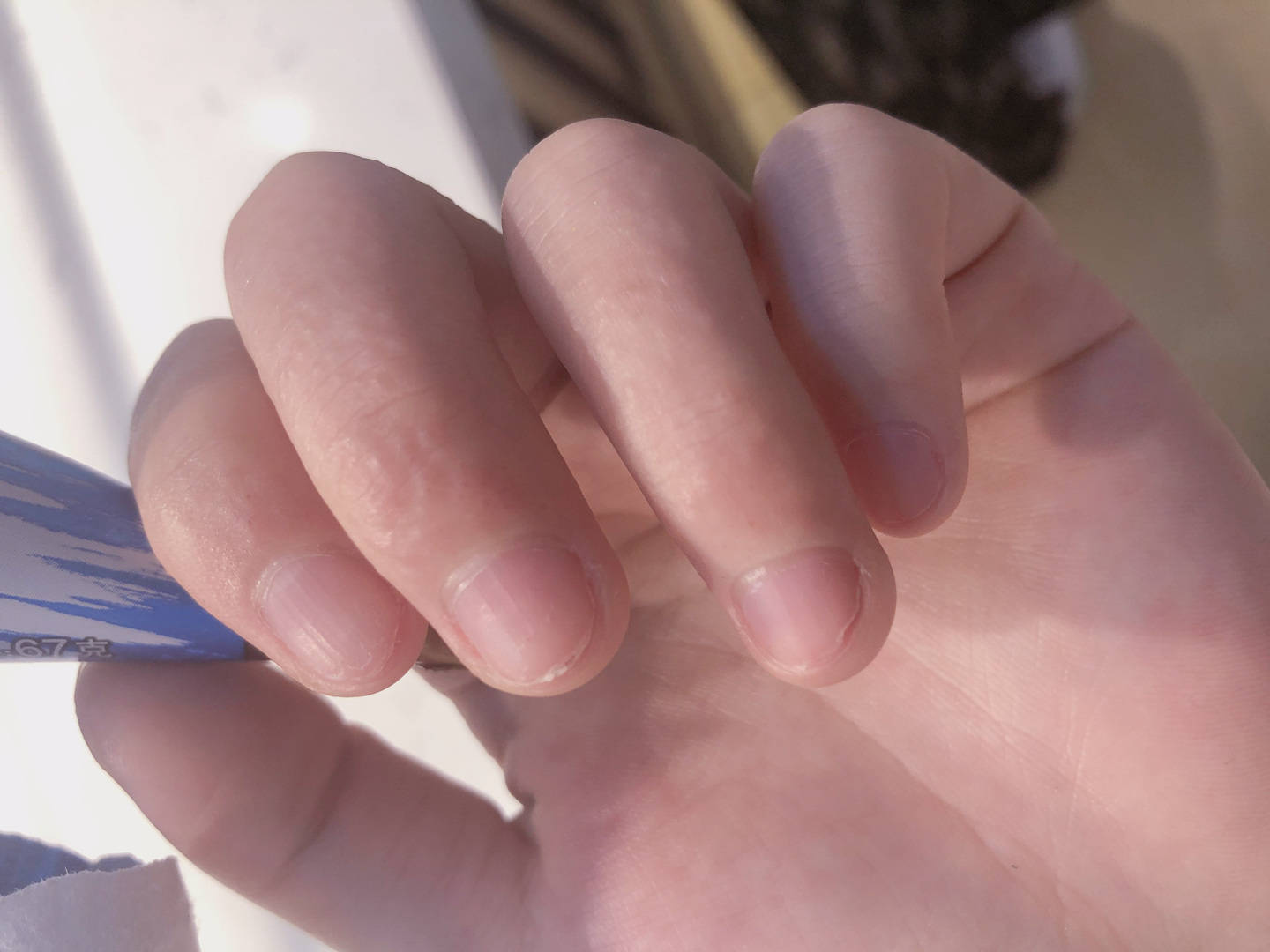 37岁,手指上起针眼样的小水泡,好烦人_手心_食物_大蒜