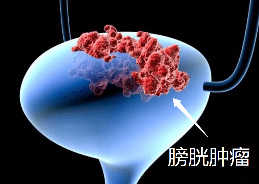 曾育林醫師為朱大爺實施腹腔鏡下根治性膀胱全切術 迴腸膀胱術 雙側