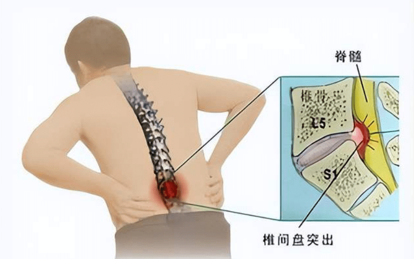 你有没有想过脚麻腿麻是腰椎的问题