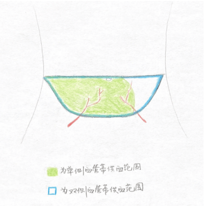 (带有双侧血管蒂的diep皮瓣示意图)(乳房再造示意图)为了实现刘女士