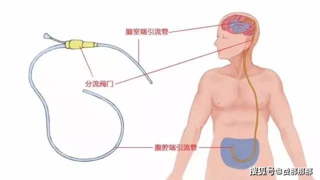 脑室腹腔引流管图片图片