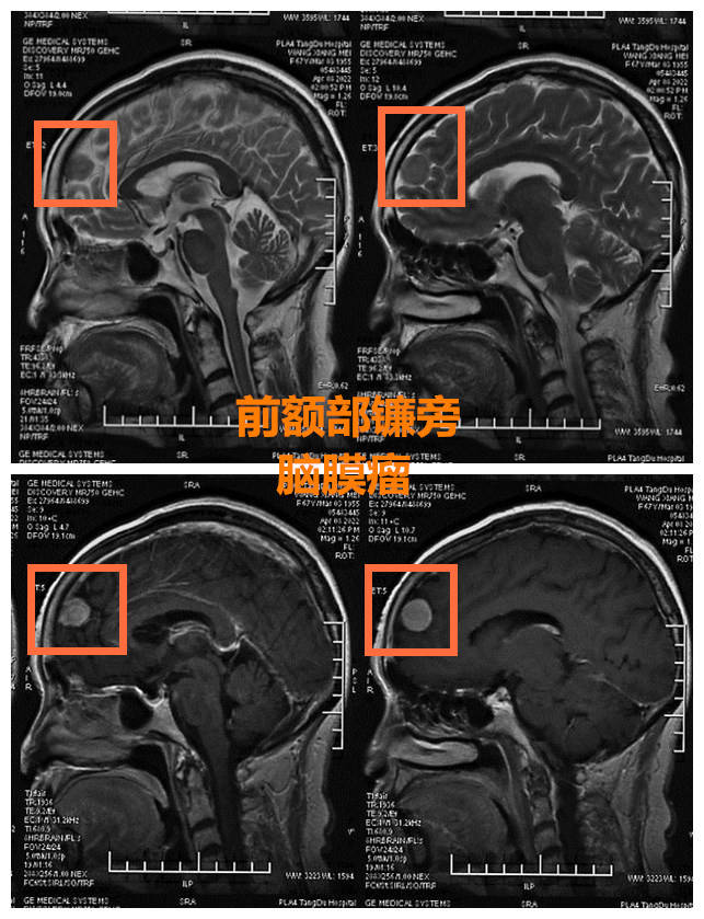 術前檢查術前會診中,趙天智主任介紹:由於患者的兩個腫瘤位置較遠無法