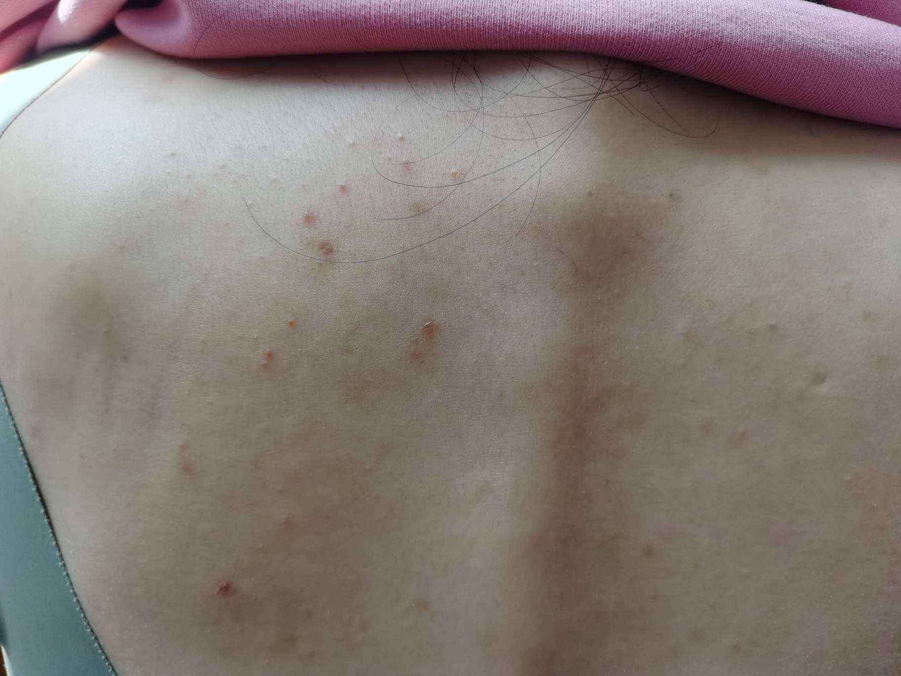 背部螨虫症状图片图片