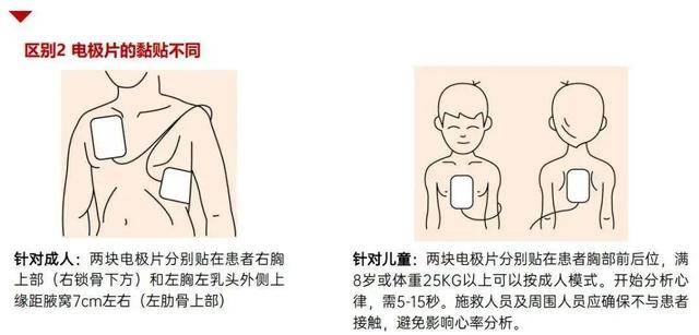 新生儿电极位置图片图片