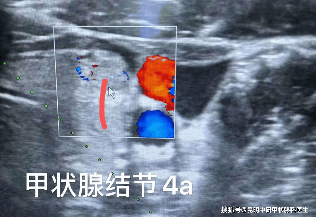 以針代刀甲狀腺結節微波消融術